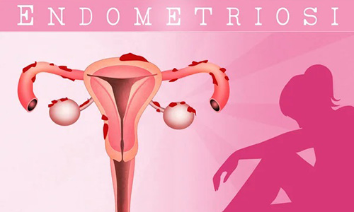 ENDOMETRIOSI